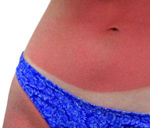 Sun Damaged Skin Treatments Portland